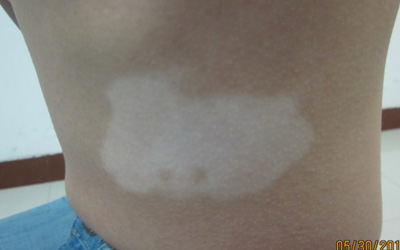 白癜风怎么区分纯白色还是浅白色瓷白色