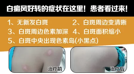 白癜风复色过程图解