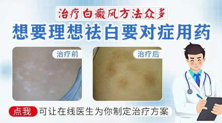 治疗白癜风的芦可替尼乳膏多少钱一盒