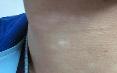 脖子下边黄豆大的白斑有两个是什么