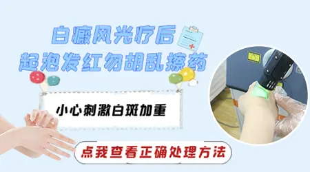白癜风照光后皮肤发红起泡是正常反应吗
