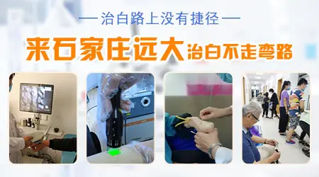 白癜风长在脸上能不能用粉底遮盖