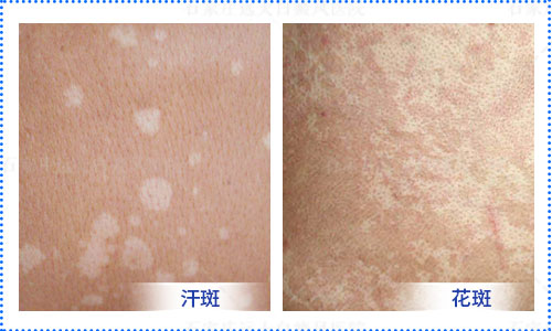 孩子身上有白色的斑块是什么情况