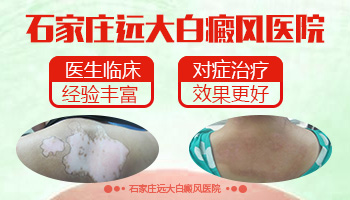 外伤引起白癜风可以移植黑色素吗