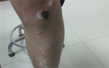 大腿根部有白色斑点一年多了是什么原因