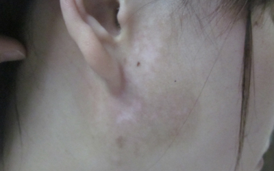 脸蛋接近耳朵后面白斑比较光滑