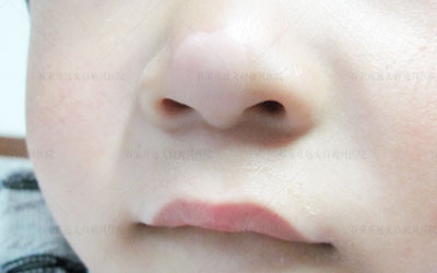 婴幼儿身上有一块白斑会是白癜风吗