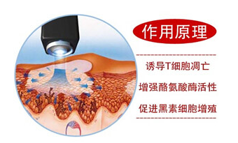 308激光治疗白癜风一个疗程多少钱 