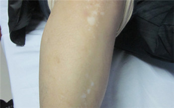 宝宝大腿上有白斑图片宝宝大腿上有白斑的图片有很多种,如果图片是