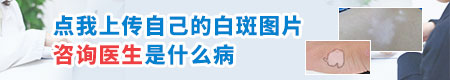 会扩散的白斑一定是白癜风吗