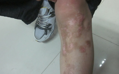 白癜风好转的图片过程 治好白癜风多少钱