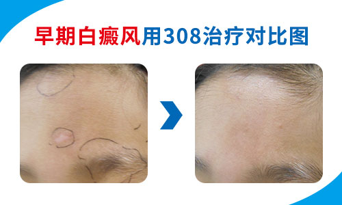 婴儿额头有一片皮肤变白是怎么了