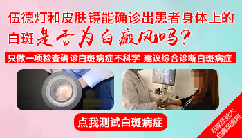 伍德灯和皮肤镜不能确定白癜风吗