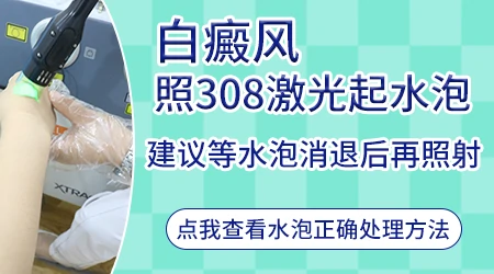 308激光照白斑起泡了怎么快速缓解