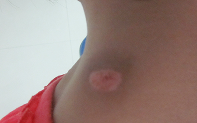 颈部抓伤后形成白斑怎么回事