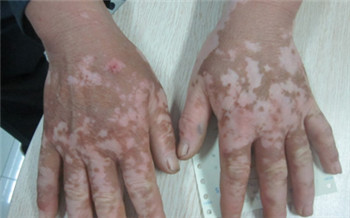 手背上起小白点图