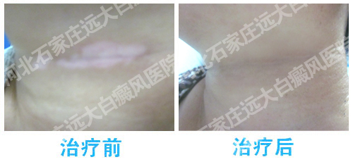 白癜风黑色素移植可以和原来皮肤一样吗