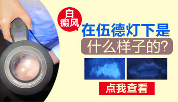伍德灯下各种白斑的颜色 白癜风是什么样的