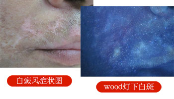 白癜风表面粗糙吗 初期白斑症状