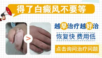三甲医院治疗白癜风贵吗
