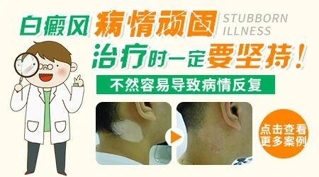白癜风治疗期间白斑扩散怎么办