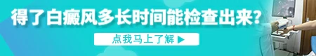 确诊白斑是不是白癜风做伍德灯检查吗