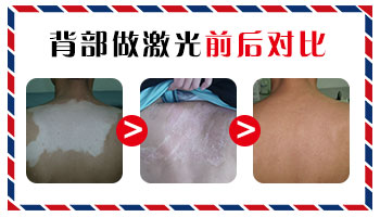 白癜风照了激光也没什么效果是怎么了