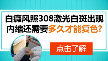 白癜风照308激光有了色素岛多久整体复色