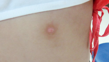 后背长了好多的白点图片