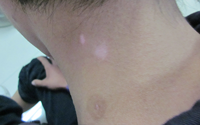 脖子附近有白色斑点 长白点是什么原因