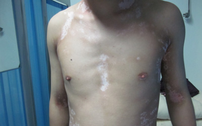 身上米粒大小白点图片