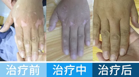 白癜风肢端型能痊愈吗