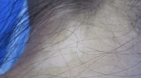 小孩脖子上有白点怎么回事