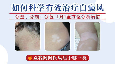 白癜风是不是一开始就是那种边界清晰的