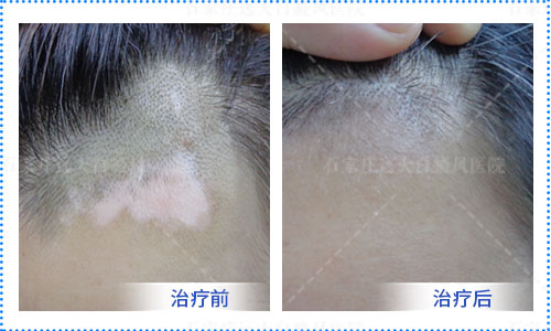 308激光要照多久白癜风才能治好