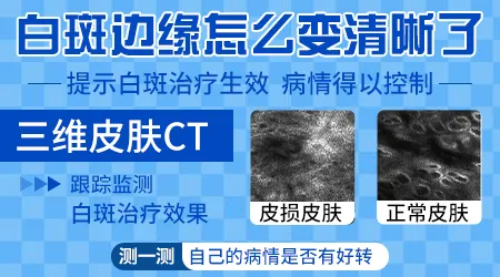 白斑边界从模糊变清晰代表进入稳定期了吗