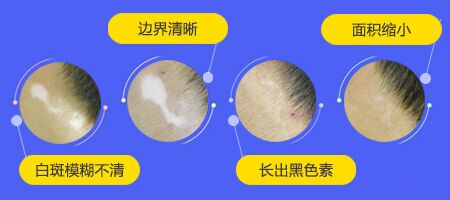 白癜风光疗的恢复过程是怎样的