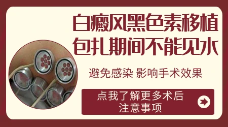 腿上白癜风种植需要住院吗