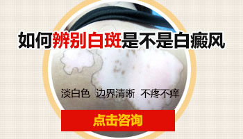 白斑早期症状如何辨别