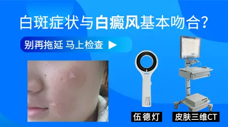 白癜风早期典型症状表现有哪些