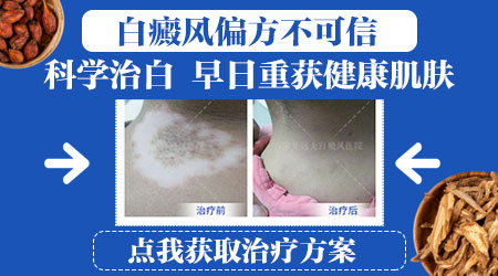 根治白癜风的土办法有哪些
