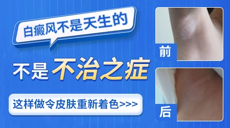 白癜风能治好吗 治疗白斑方法