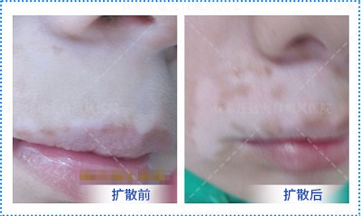 嘴唇上也有一点白是得了白癜风吗