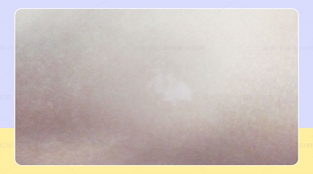 婴儿身上一大块特别白的白斑