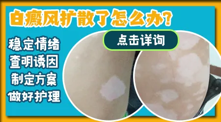 白癜风变大了怎么办 有什么方法能控制