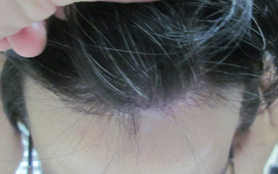 女孩额头右边白斑是不是白癜风