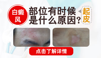 眼皮上有白块而且起皮是白癜风吗