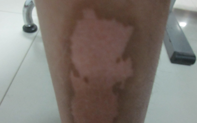 308激光治疗白斑前后对比照