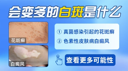 身上白癜风白点越来越多怎么才能有效控制住