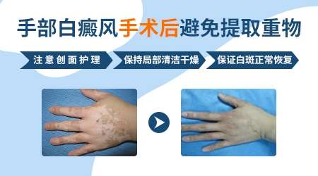 肢端白癜风白斑做黑色素种植的成功率高不高